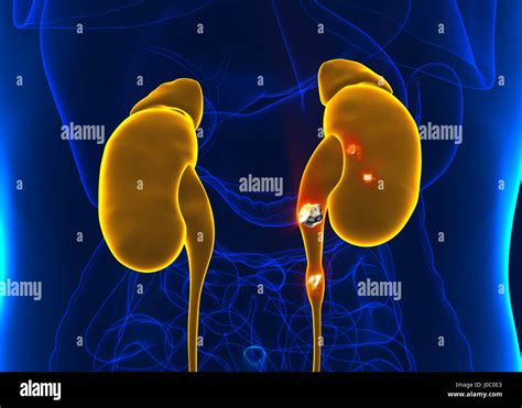 Kidney Stones Anatomy Pain Male Internal Organ Painful Cristaline