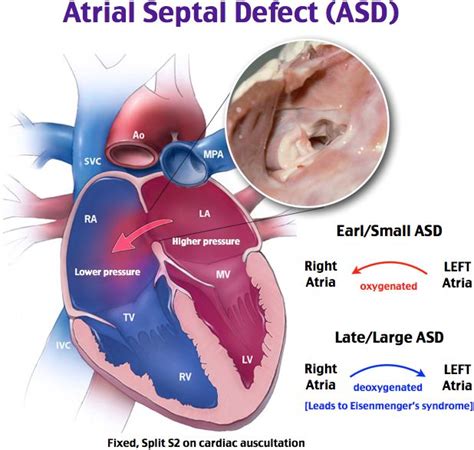 Atrial Septal Defect Oxygenated Blood Moves From Left Atrium To Right