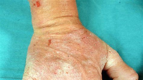 Dermatitis Herpetiformis Causes Symptoms And Diagnosis