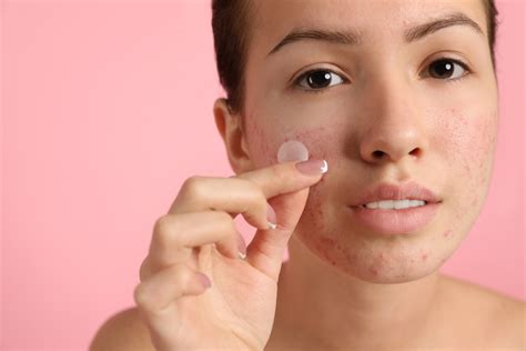 Why Popping Pimples Is Bad For Your Skin