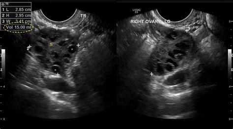 Polycystic Ovarian Syndrome Radiology At St Vincents University