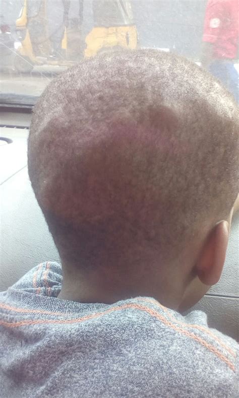 Multiple Bumps On My 3-Year-Old Boy Scalp. | 2020 JAMB and ...