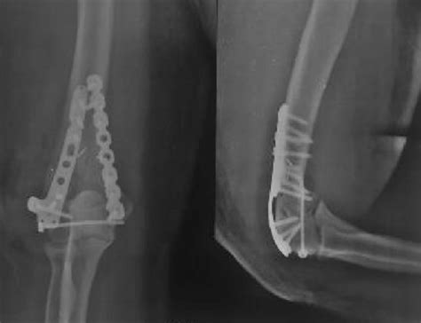 Post Operative Radiographs At Three Weeks In Anteroposterior And