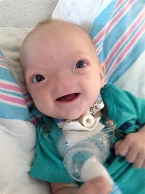 The Cutest Baby On Facebook Was Born With A Rare Condition