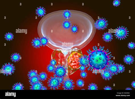 Viral Etiology Of Prostate Cancer Conceptual Illustration Showing Viruses Infecting Prostate