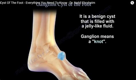 Ganglion Cyst Of The Foot Orthopaedicprinciples Com