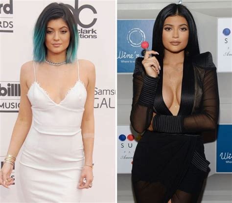 Kylie Jenner After And Before Pictures Did She Do Surgery Demotix