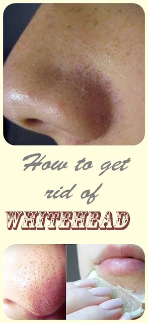 How To Get Rid Of Whiteheads Top 5 Diy