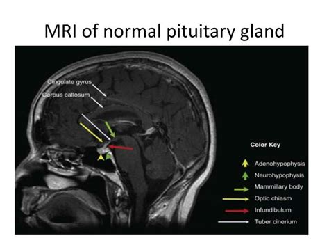 Pituitary Gland Tumor Mri