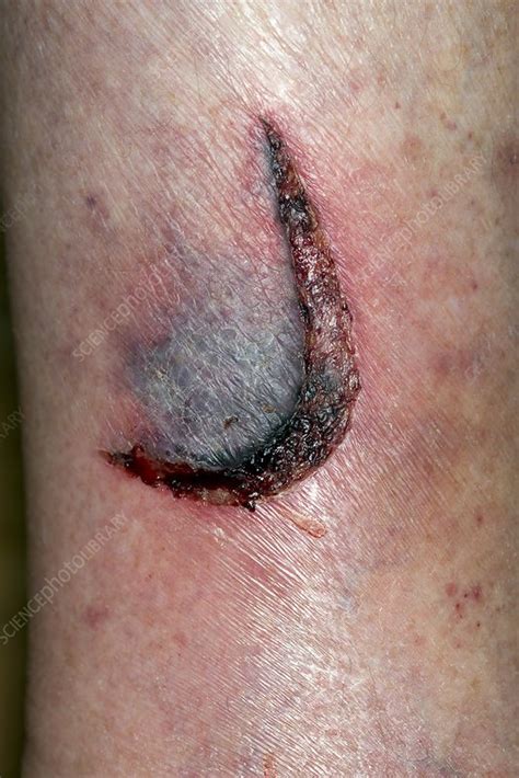 Laceration to the arm - Stock Image - C021/3388 - Science Photo Library