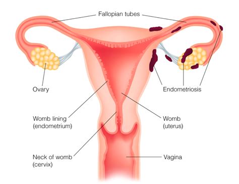From pathogenesis to the recognition of distinct disease keywords: Endometriosis - Global Women Connected