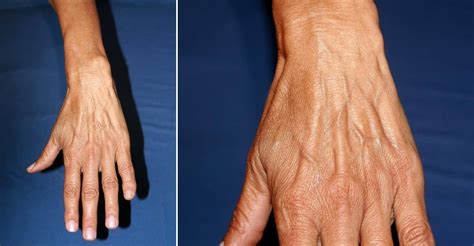 Hand Vein Causes And Treatments San Diego Cardiac Vein And Laser Center