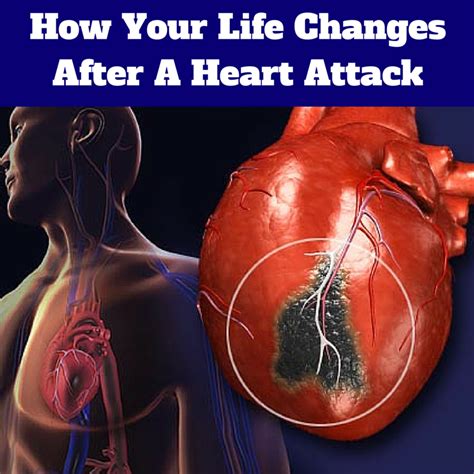 How Your Life Changes After A Heart Attack Causes Of Heart Attack
