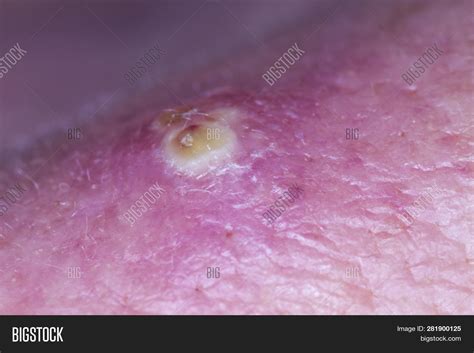 Purulent Red Pimple On Image And Photo Free Trial Bigstock
