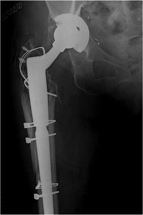 Treatment Of Intraoperative Trochanteric Fractures During Primary And