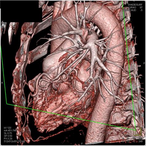 Left Anterior Descending Coronary Artery Aneurysm Cardiac Case