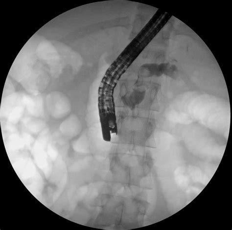 Endoscopic Retrograde Pancreatogram Demonstrating Pancreatic Duct
