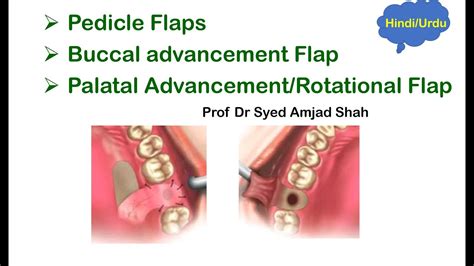 Pedicle Buccal Advancement Palatal Advancement Rotational Flaps