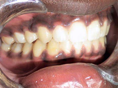 What Are The Types Of Overbite