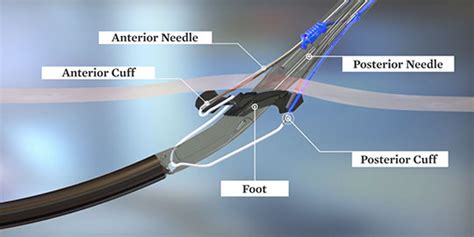On Demand Resources For Perclose Prostyle Suture Mediated Closure
