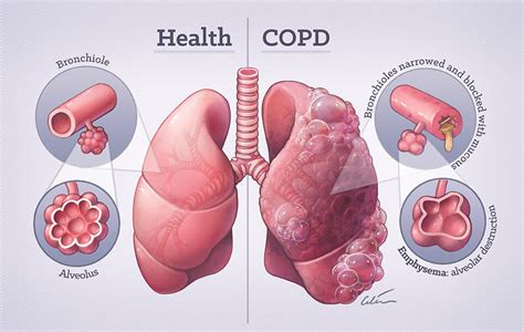 Chronic Obstructive Pulmonary Disease Copd — Mrinz Medical Research Institute Of New Zealand