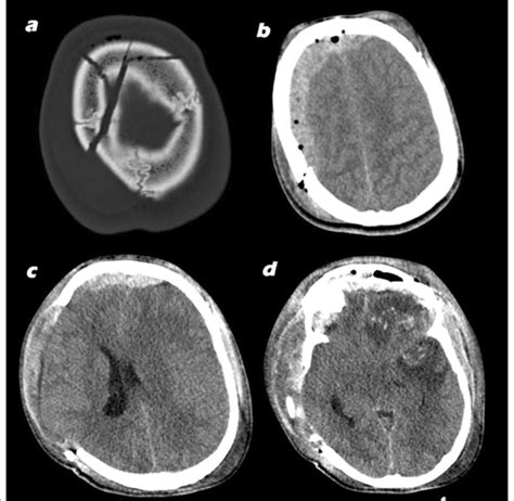 A Fracture Of Right Parietal Bone Extending Through Coronal Suture To