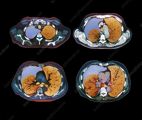Getting involved in the journal opportunities are now available to join our editorial board, overseeing papers, generating ideas for special issues and keeping our international readership up to date on the latest research. Pneumothorax, CT scan - Stock Image - C013/2177 - Science ...