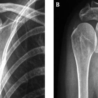 Calcifying Tendonitis And Radiological Calcification Type Resorptive Download Scientific