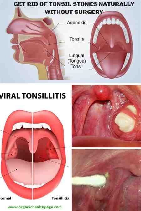 White Spot On Uvula And In Tonsils Tonsil Dr League