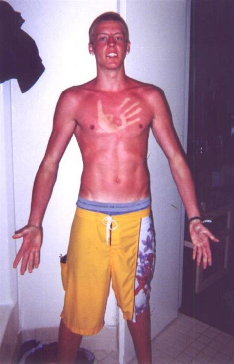 Sunburns Are No Joke Remember To Apply Sunscreen Every Few Hours In