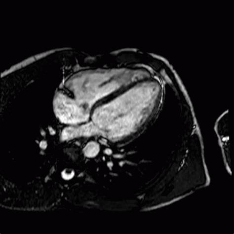 Cardiac Mri Cardiac Mri Heartbeat Descobrir E Compartilhar GIFs