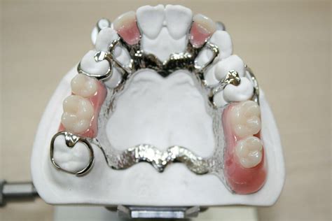 Removable Partial Dentures Baluke Dental Studios