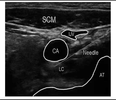 Figure 1 From Effects Of Ultrasound Guided Stellate Ganglion Block On