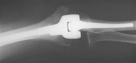 Total Elbow Joint Replacement For Elbow Arthritis Uw Orthopaedics And