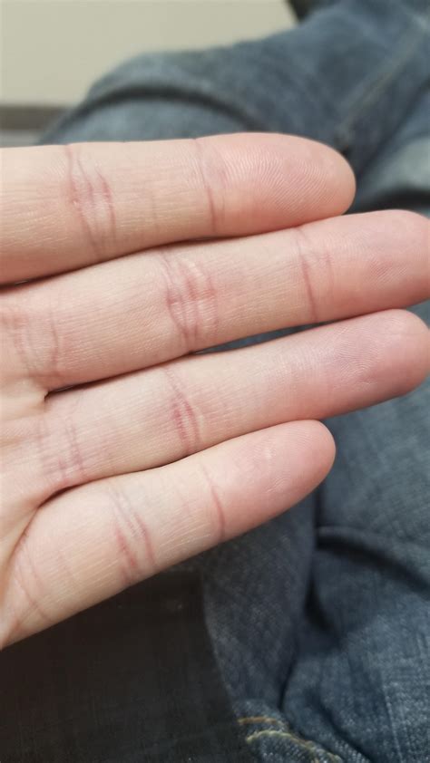 Finger crease disappeared after only 4 months of knuckle not working ...