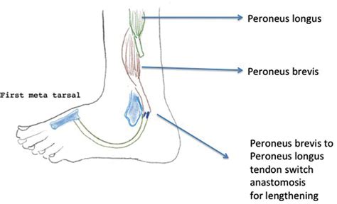 Schematic Diagram Showing Peroneus Longus To Peroneus Brevis Tendon