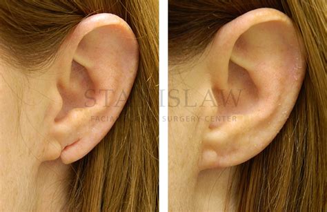 Earlobe Repair Gallery 6 Before And After Photos Connecticut