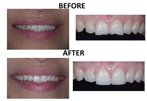Best Tooth Contouring In Nyc Before And After Photos Of Tooth