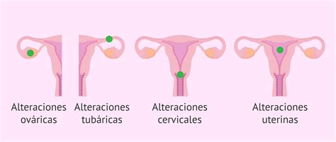 ¿por Qué Se Produce La Infertilidad Femenina
