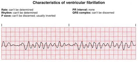 Una forma particolare di tachicardia ventricolare è la torsione di punta: Pin on Ventricular Fibrillation