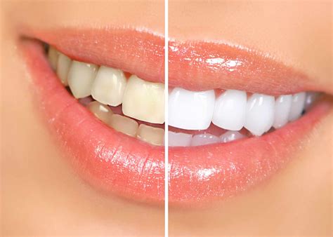 mayo clinic q and a many safe choices available to help whiten teeth mayo clinic news network