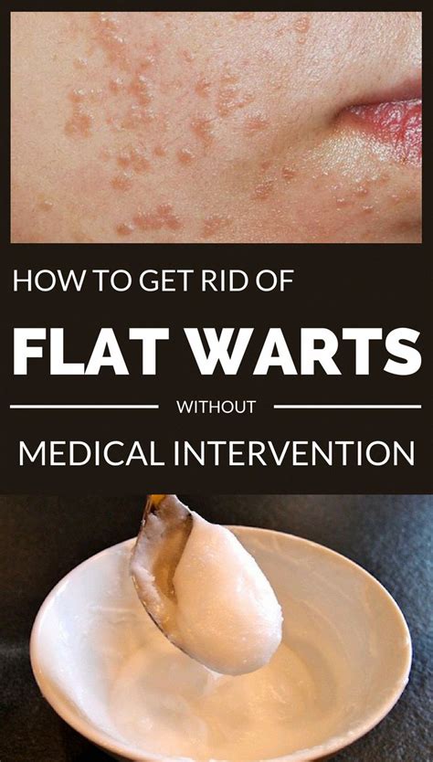 The One Thing To Do For Get Rid Of Warts Healthy Medicine Tips Flat