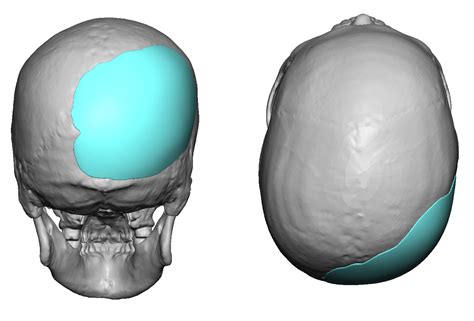 Plastic Surgery Case Study Right Occipital Plagiocephaly Custom Skull