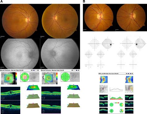 Representative Images And Test Results For A Patient With Macular Hole