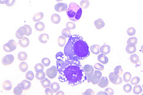 Aml Erythroid Leukemia Hematomorphology A Databank Imagebank For