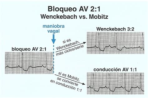 Electrocardiograma Bloqueos Aurículo Ventriculares
