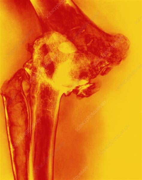 Col X Ray Of Rheumatoid Arthritis Of The Elbow Stock Image M1100339 Science Photo Library