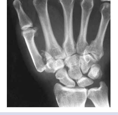 Jersey finger injuries are reasonably common, especially in athletes. Figure 12 from Injuries of the fingers and thumb in the ...