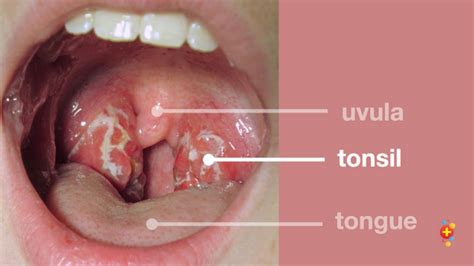 Tonsillitis Dont Forget The Bubbles