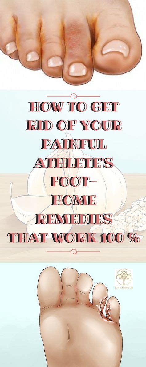 Pin By Jean Schoenborn On Athletes Foot Remedies In 2020 Athletes